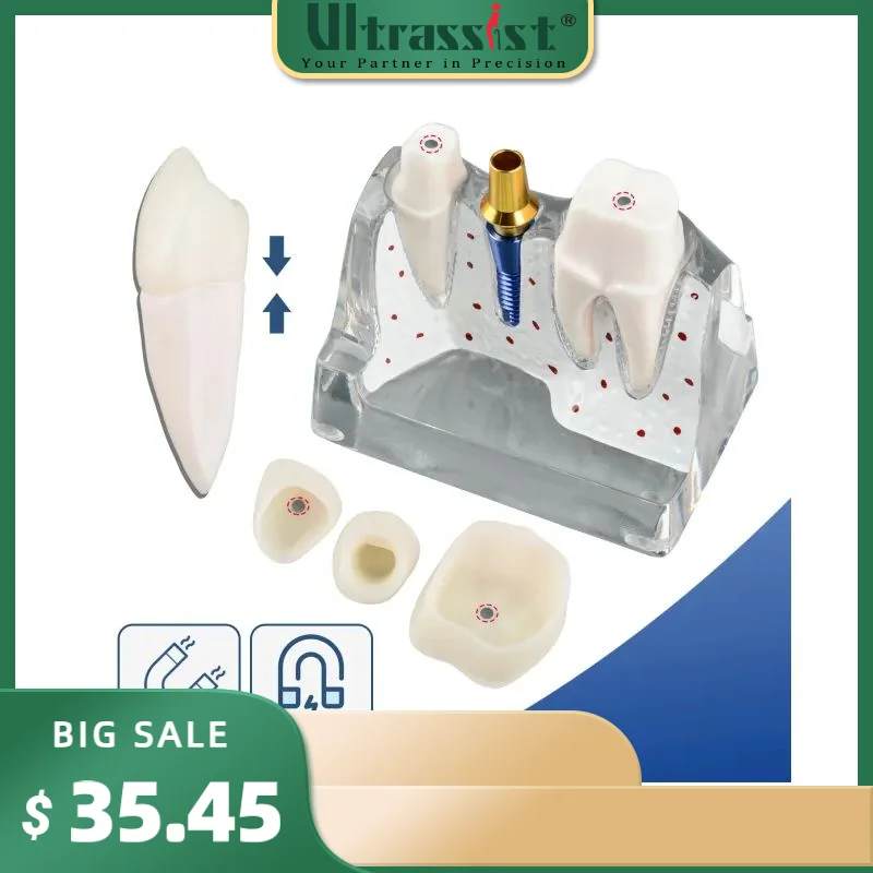 Ultrassist Dental Implant Model for Patient Education, 4 Times Dental Implant, Crown and Bridge Model for Presentation-Transpare