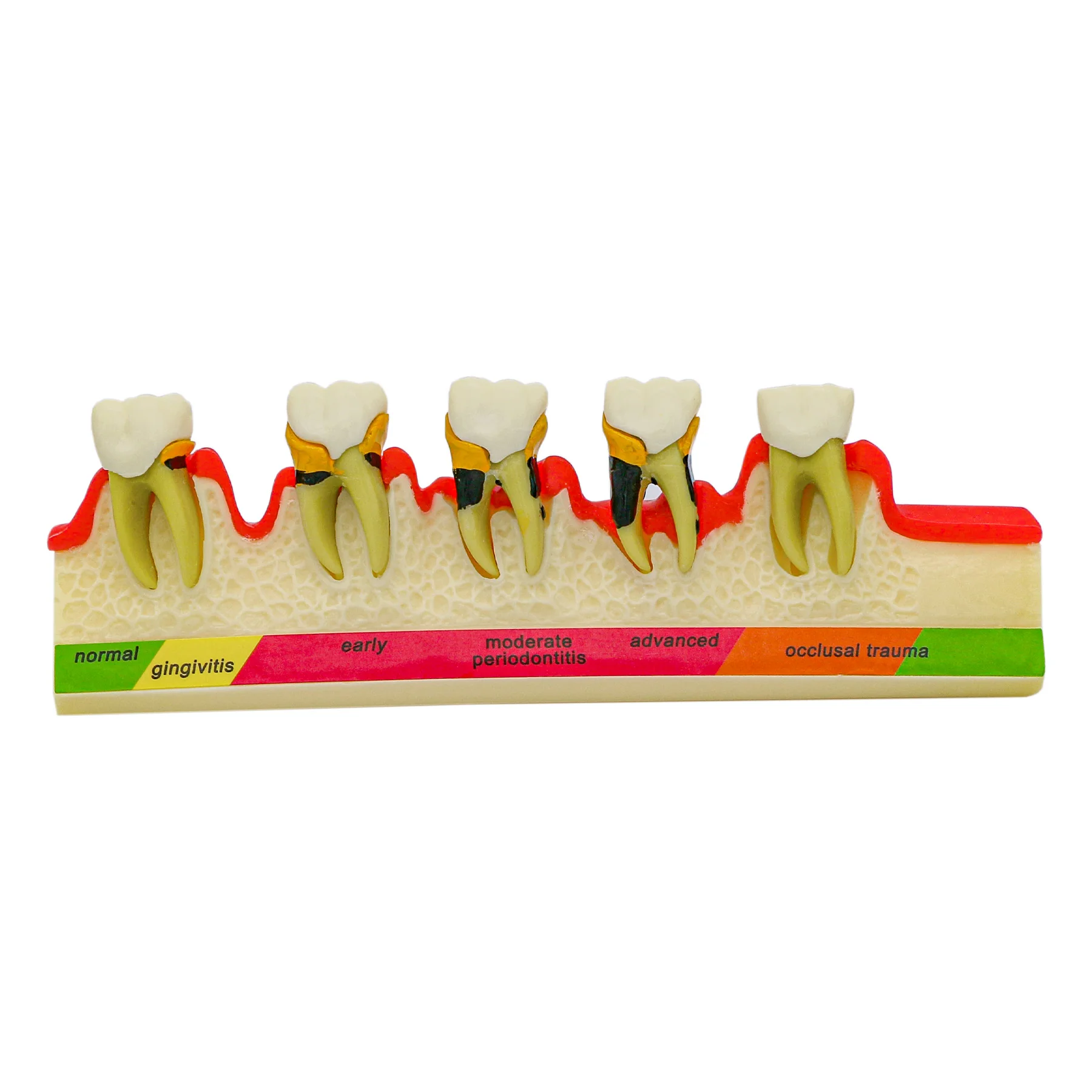 

Dental Periodontal Disease Model M4010 Typodont Teeth Model Periodontics