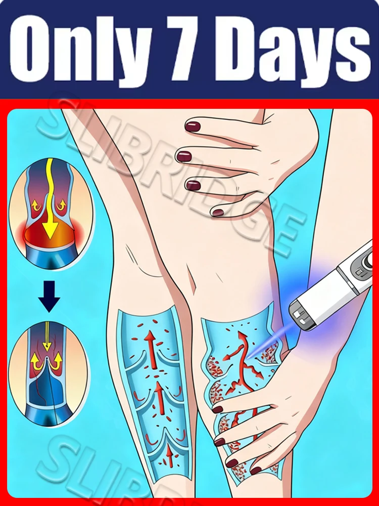 blue light pen solve veins,foot care tools, unisex,2025 hot sale