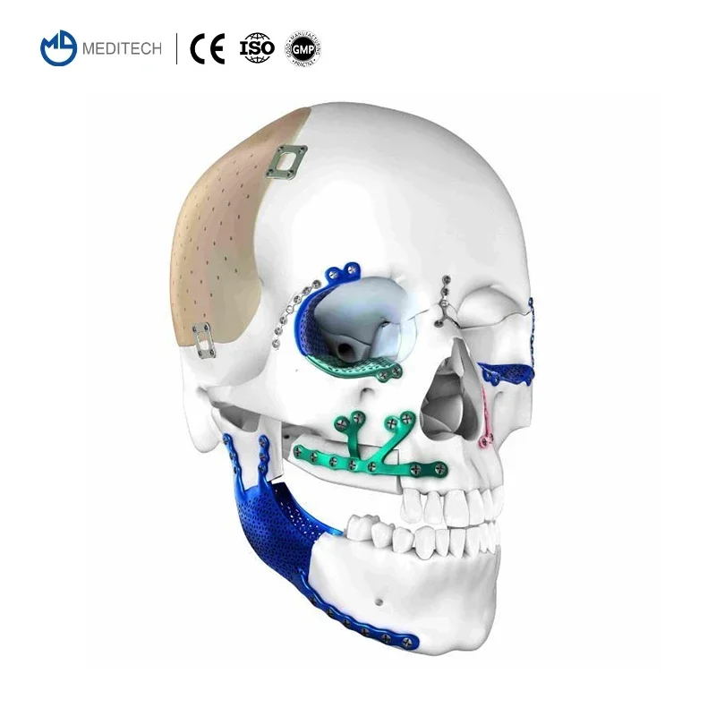 MEDITECH Chirurgisch Maxillofacial Neurochirurgie Systeem Cranial Titanium Mesh Plaat voor Schedel Cranioplastie
