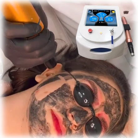 Professional Diode Pico Laser Tattoo Removal Machine with Carbon Peeling 532nm/755nm Wavelengths Portable for Eyebrow Treatment
