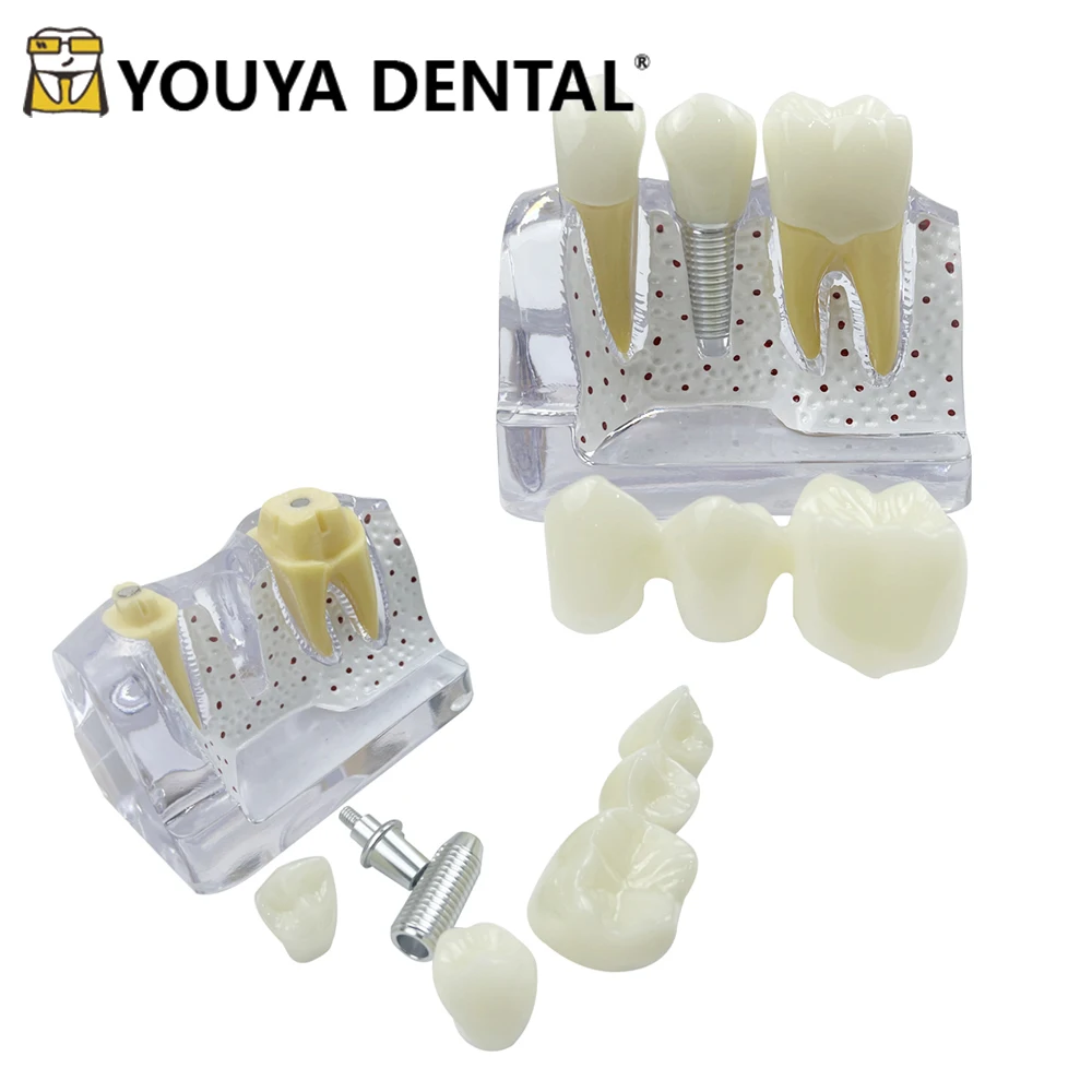 Dental 4 Times Implant Teeth Teaching Model for Dentist Student Practice Studying Training Doctor-patient Communication Tools