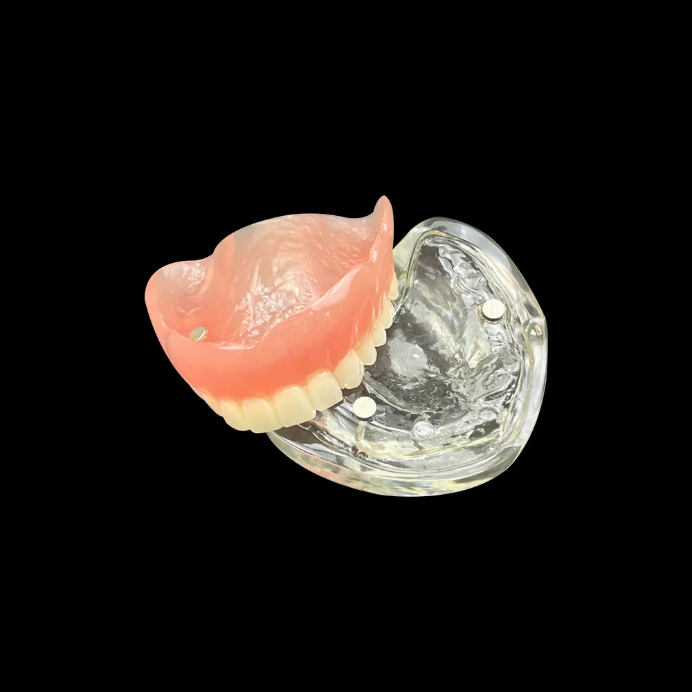 1 Pcs Upper/Lower Jaw Implant Removable Overdenture Tooth Model With 2 Implants Typodont Model Suitable Dentist Teaching Demo