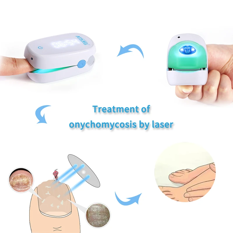 Atang – dispositif Portable pour les ongles, traitement des champignons, Infection au Laser, couleur grise