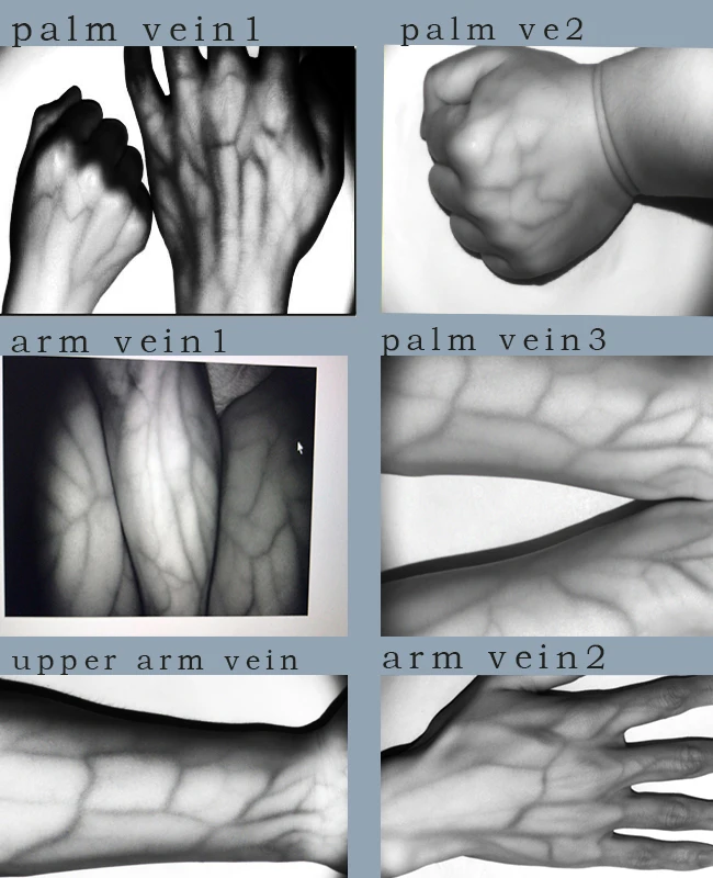 Medical-assisted injection to find veins to help doctors locate venous devices Vein observation system Vein