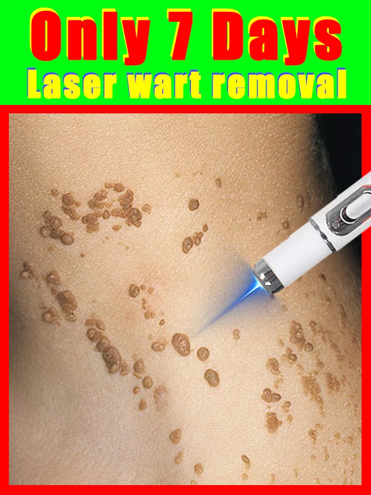 

beauty,blue light pen solve warts,painless,wart care tools,free shipping