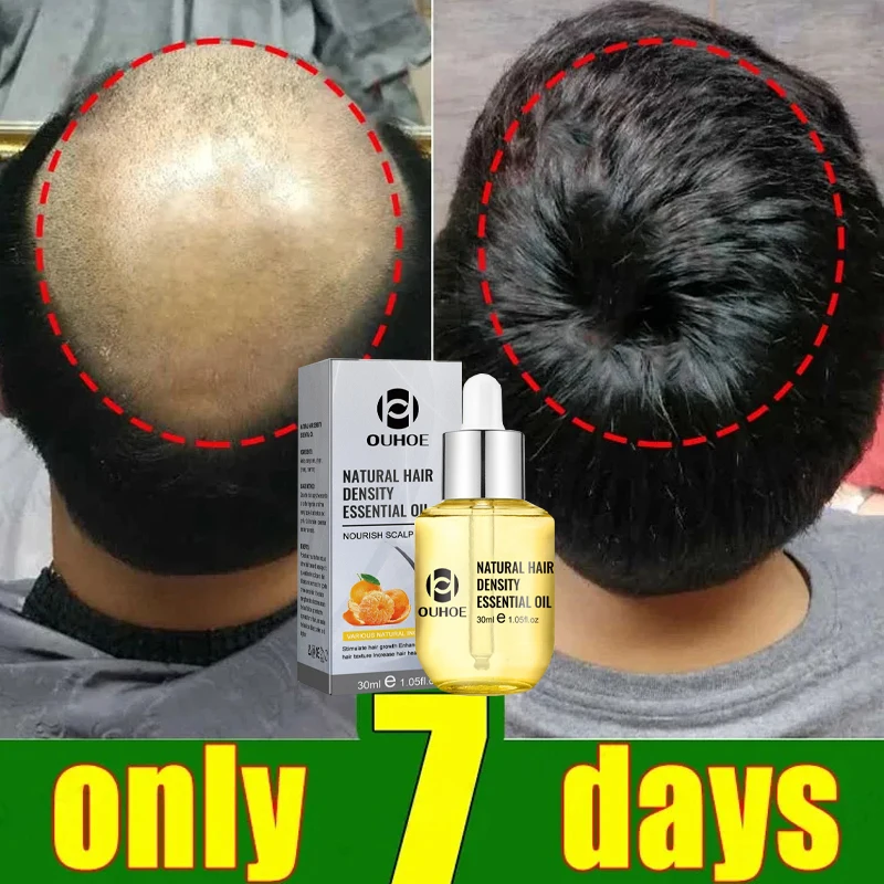 

Ginger Hair Growth Essential Oil for Men Women Anti Hair Loss Scalp Treatment Regrowth Thicken Hair Care Serum Product