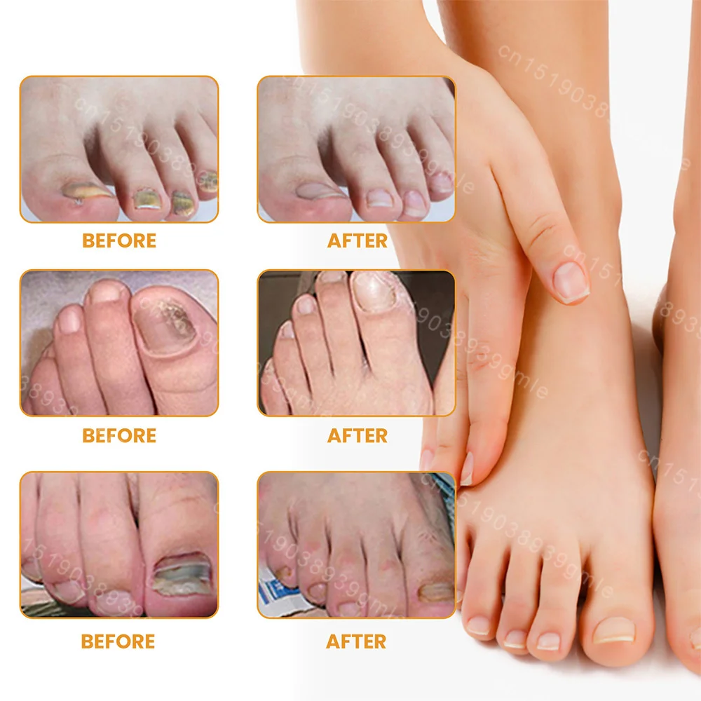 Ingrown Toenail Correction Tool Nail Filling Pad Ingrown Toe Nail Treatment Elastic Patch Straightening Clip Brace Pedicure Tool