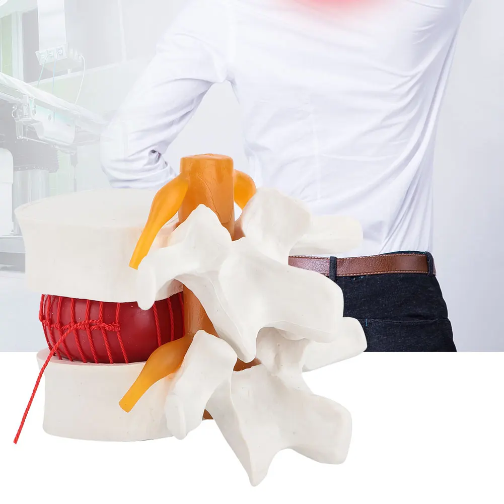 1:1.5  Demonstration Model Of Lumbar Vertebral Spine Human Lumbar Disc Herniation Model Lumbar Model Lumbar Spine Model