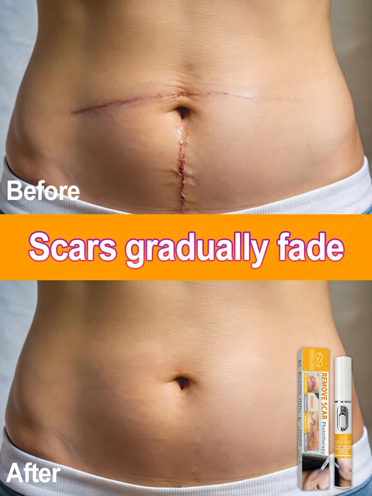 

Keloid laser treatment Scar beauty Special laser fast removal of burns