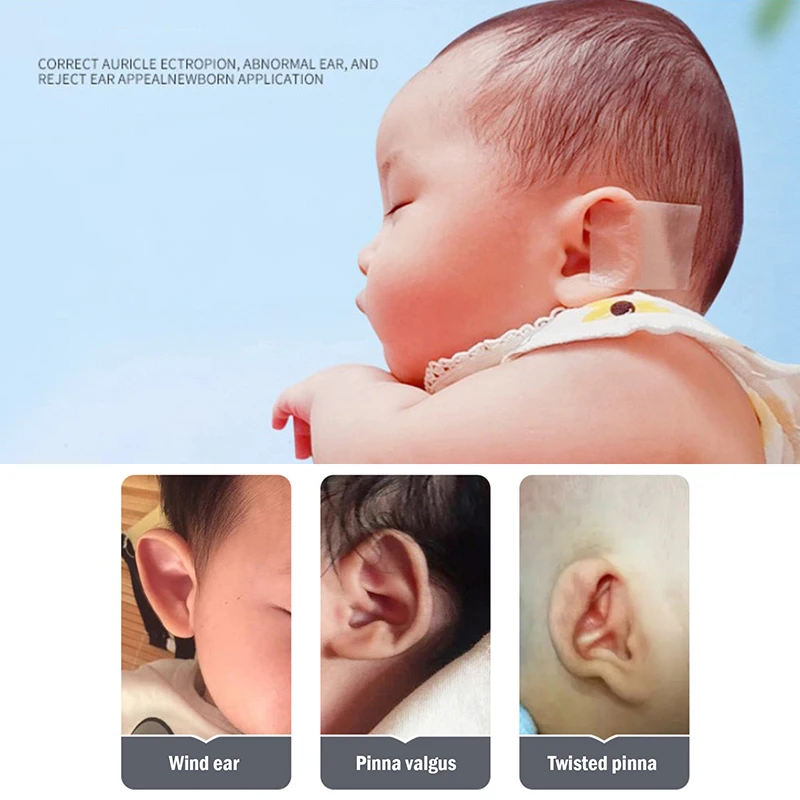 Baby Ear Corrector Infant Protruding Ears Correction 4 x 50cm Silicone Kids Ear Aesthetic Correctors Patch Sticker