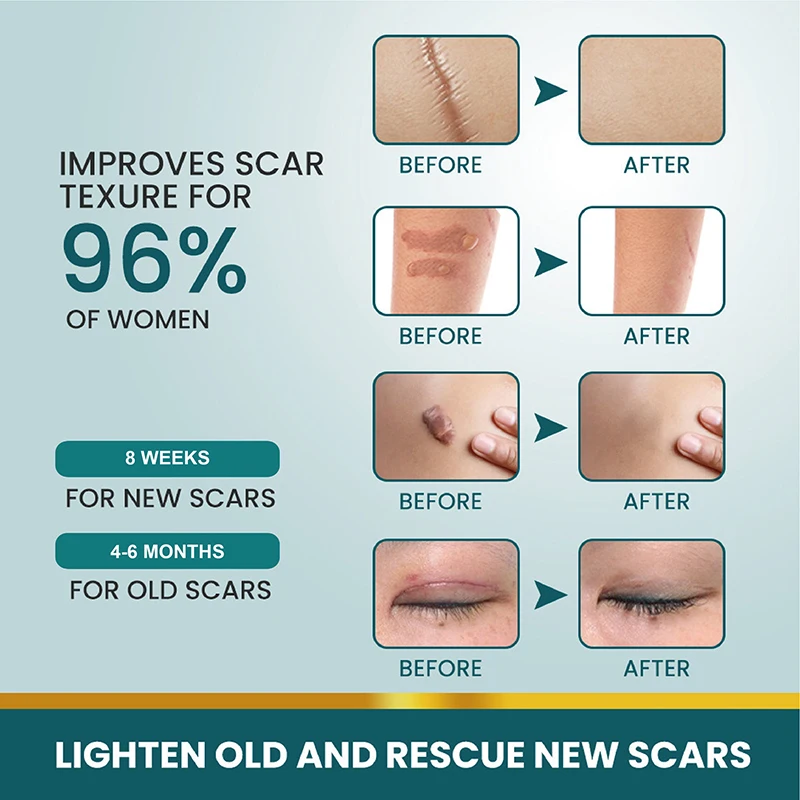1 Roll Silicone Scar Sheets Gel Scar Patch 4cmX150cm Self-Adhesive Scar Cover Tape Reusable And Effective Skin Care Strips