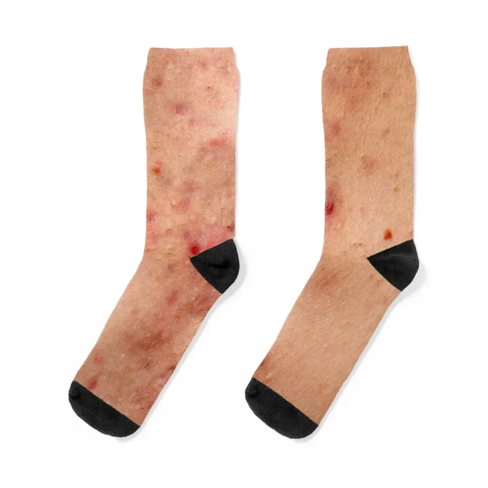 Acne skin damage, red blemish on chest Socks luxe gift retro Novelties Socks Men's Women's