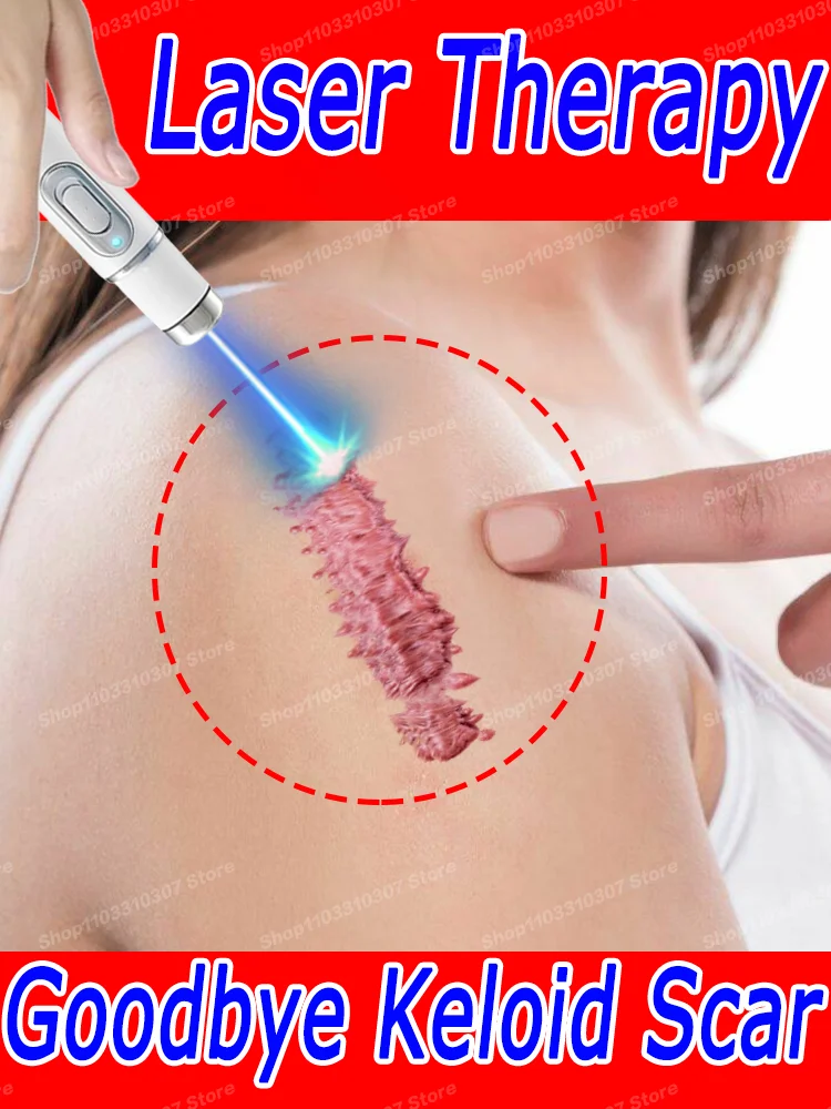 

Laser therapy Keloid scAR
