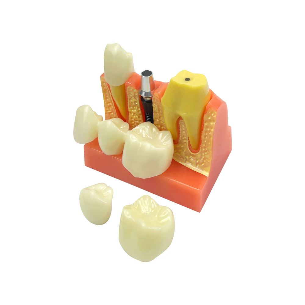 4 Times Implant Teeth Model Denture Bridge Crown Porcelain Restoration Model For Dentist Student Teaching Demonstration Module