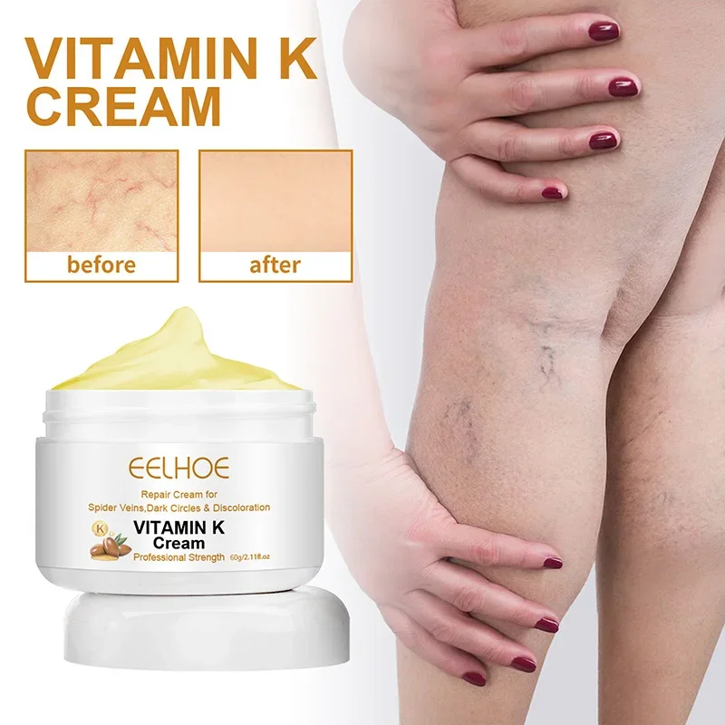 Eelhoe crema de vitamina K para masaje quirúrgico, tratamiento para piernas doloridas e hinchadas, crema para el cuidado de la piel de las piernas, gusano de tierra