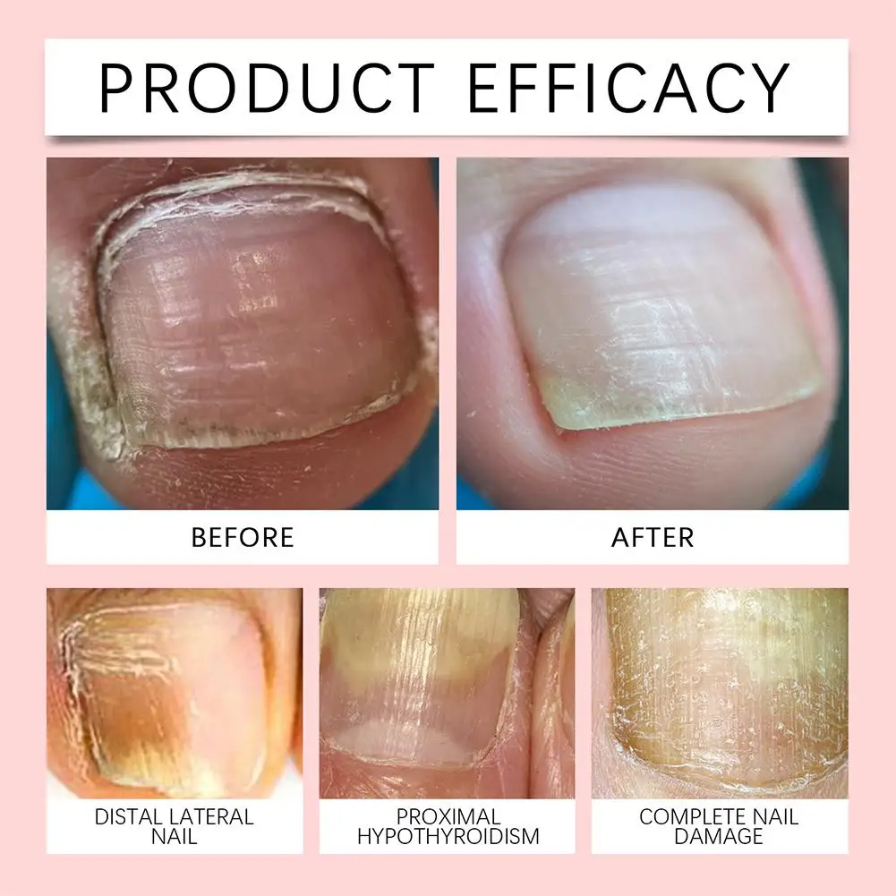 قلم العناية بالأظافر من FUNGAL، إصلاح الأظافر القوي للغاية، رعاية مغذية لأظافر القدمين السميكة أو التالفة باللون الأصفر #3