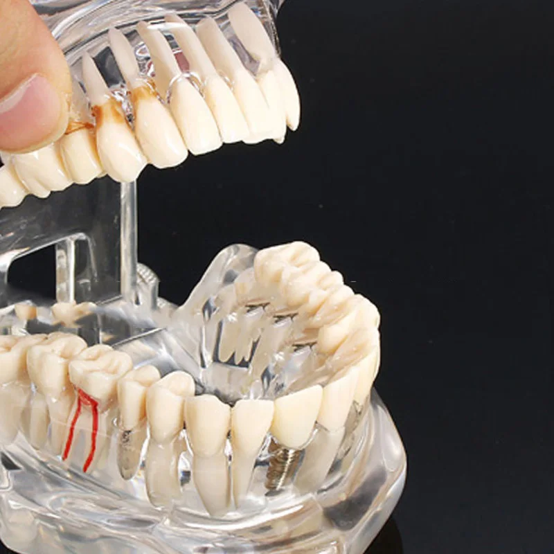 Doença dentária do implante, Modelo de dentes com ponte de restauração, Dentista para doença da ciência médica