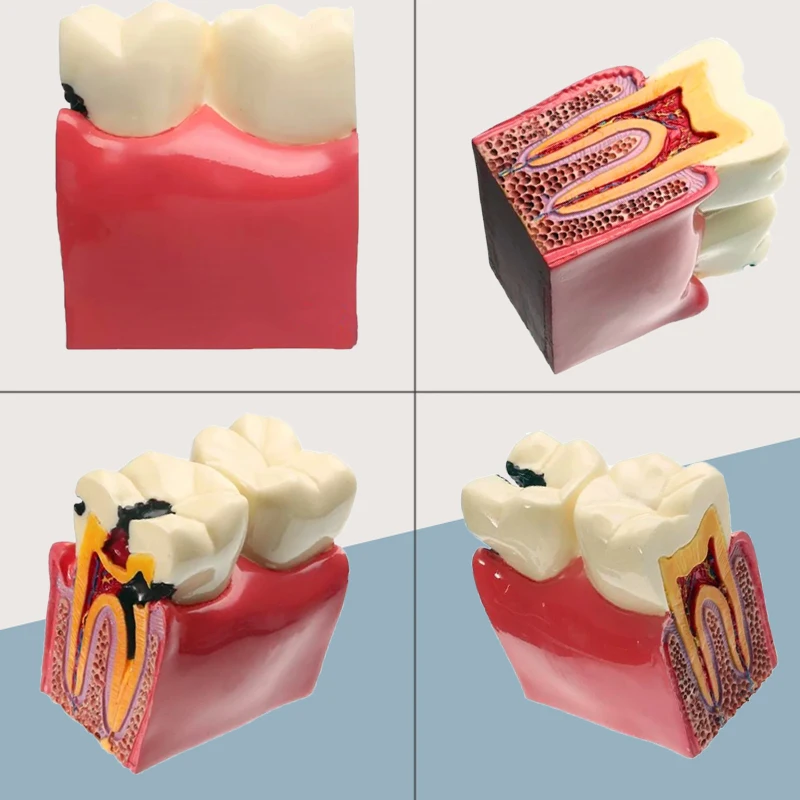 

Dental Teeth Model 6 Times Dental Caries Comparsion Study Models Tooth Decay Model For Dentistry Anatomy Education Demonstration