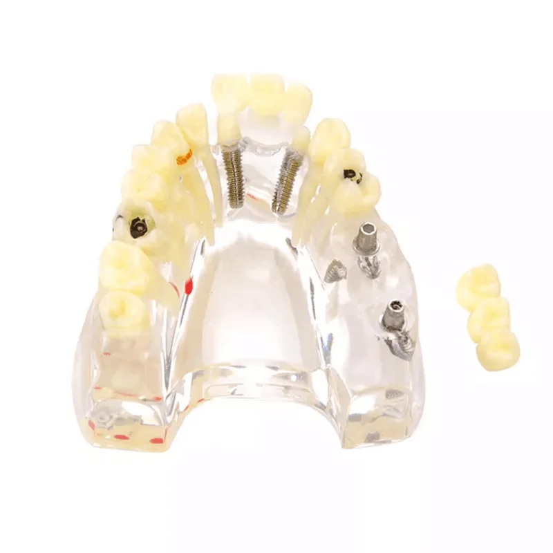 Dental Caries Implant Models Maxillary Education Practice Model Dentistry Demonstration Students Training Products M2006