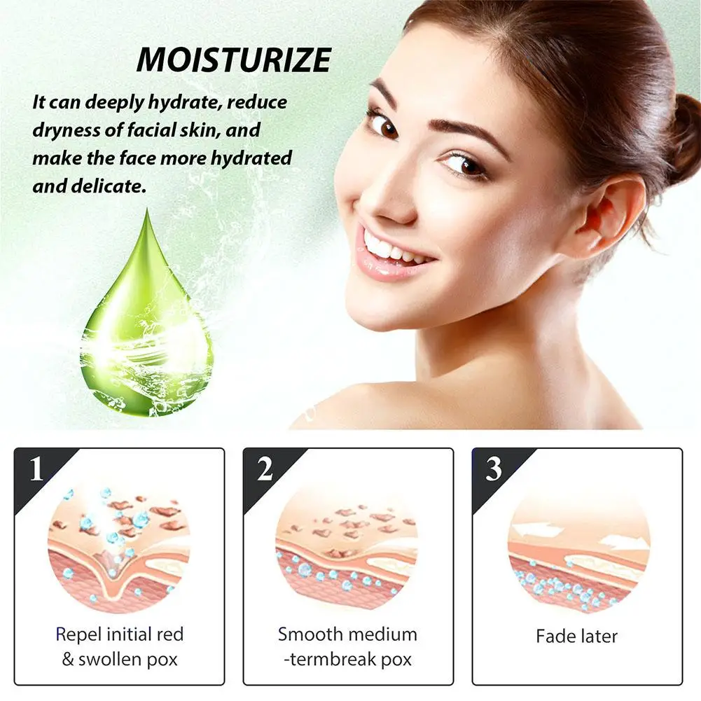 Acne rosto espinha tratamento creme, controle de óleo, reparação, hidratação, vermelhidão, cravo soro, hidratante, Poro suave, encolhendo, Re P9W3