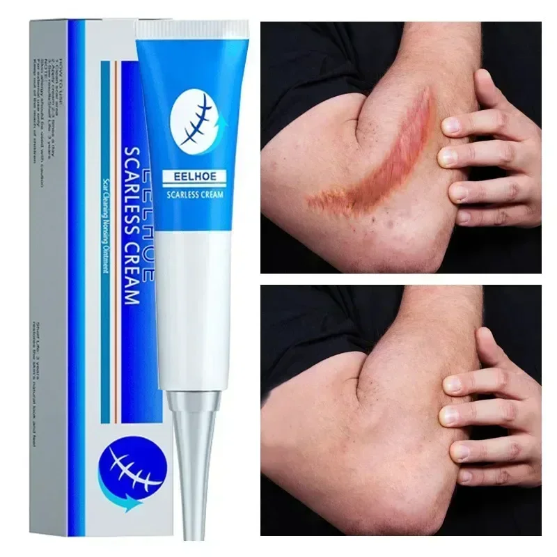 NewScar riparazione efficace cicatrici chirurgiche smagliature acne pits pockmarks burn cicatrici repair treatment 0903