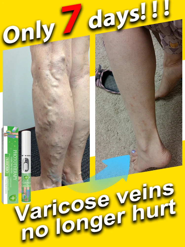 Varicose veins powerful laser