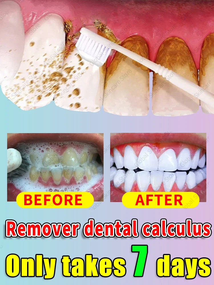 

Tartar removers dissolves tartar and eliminates stains