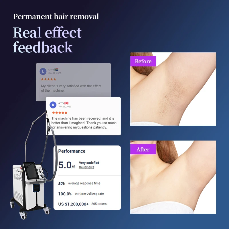 1064 Nd Yag 755 Alex Long Pulse Machine 755nm Alexander Alexandrite Laser Hair Removal
