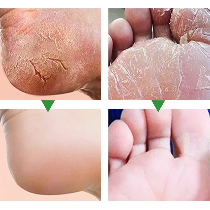 Herbal Anti Crack Foot Cream Heel Cracking Repair Products Exfoliation Dead Skin Removal Softening Moisturize Whiten Skin Care