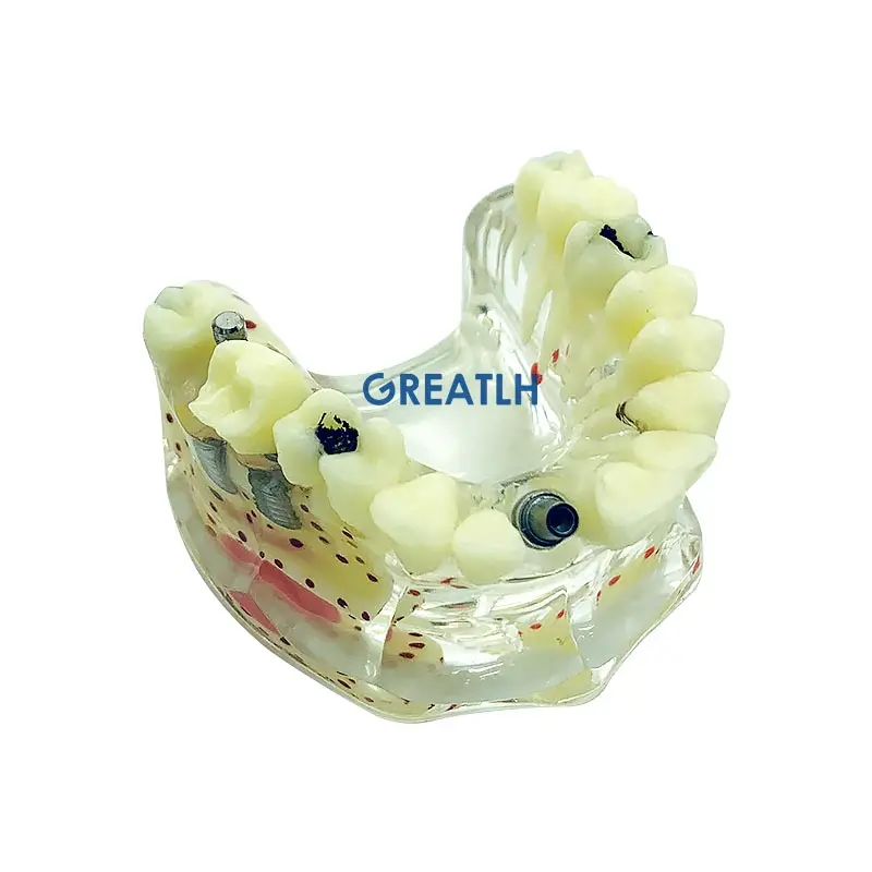 Dental Teeth Model Implant Model Teaching Learning Model Dental Materials