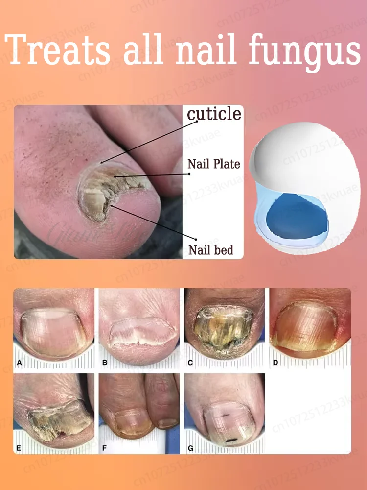 Przenośny laser do leczenia grzybicy paznokci, usuwa 100% grzybicy paznokci w ciągu zaledwie 7 dni