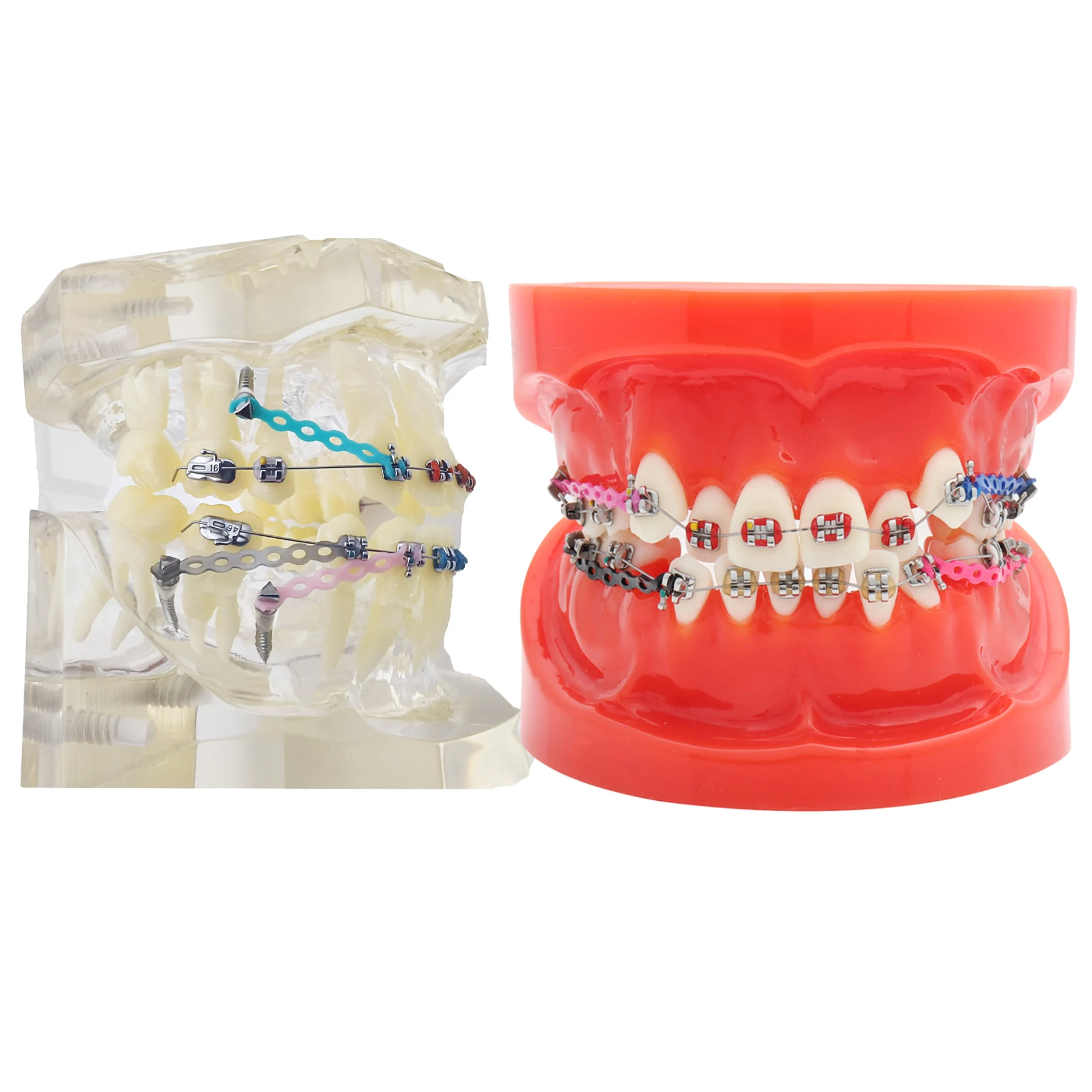 Dental Orthodontic Treatment Teeth Model Malocclusion Correction With Metal Brackets Teach Models for Dentist Communication Demo