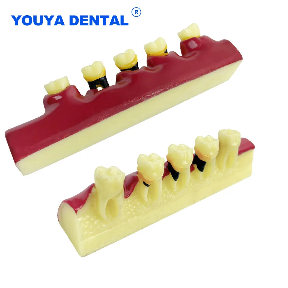 Stomatologiczny model chorób przyzębia Standardowy model zęba Demonstracja stomatologiczna dla pacjentów dentystycznych Narzędzia do kliniki