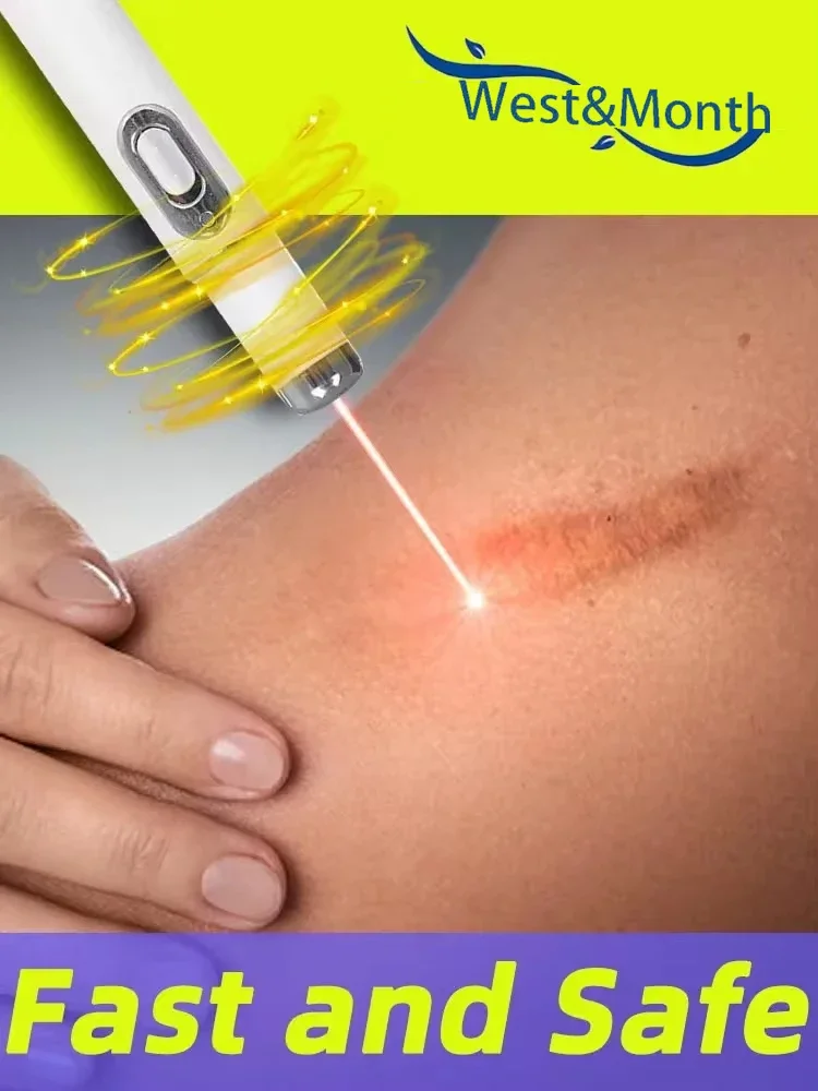 Laser therapy Keloid scar