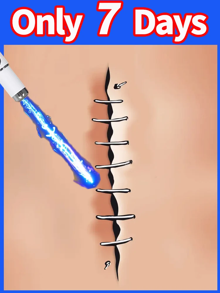 stylo-a-lumiere-bleue-pour-resoudre-les-cicatrices-outils-de-soins-des-cicatrices-offre-speciale