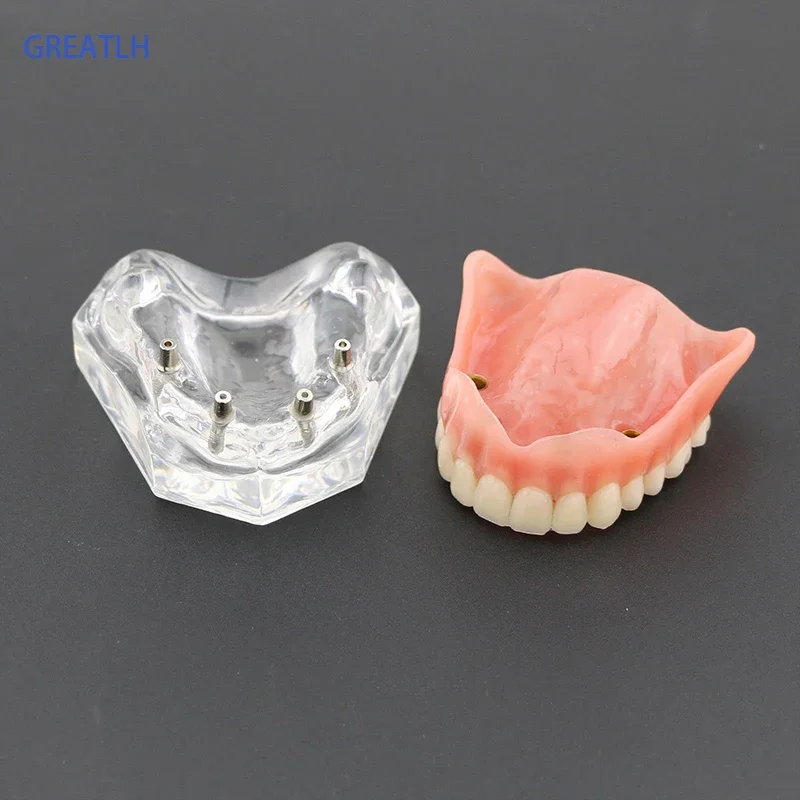 1pcs /pack Dental Upper Overdenture Superior 4 Implants Demo Model 6001 02 Teeth Model