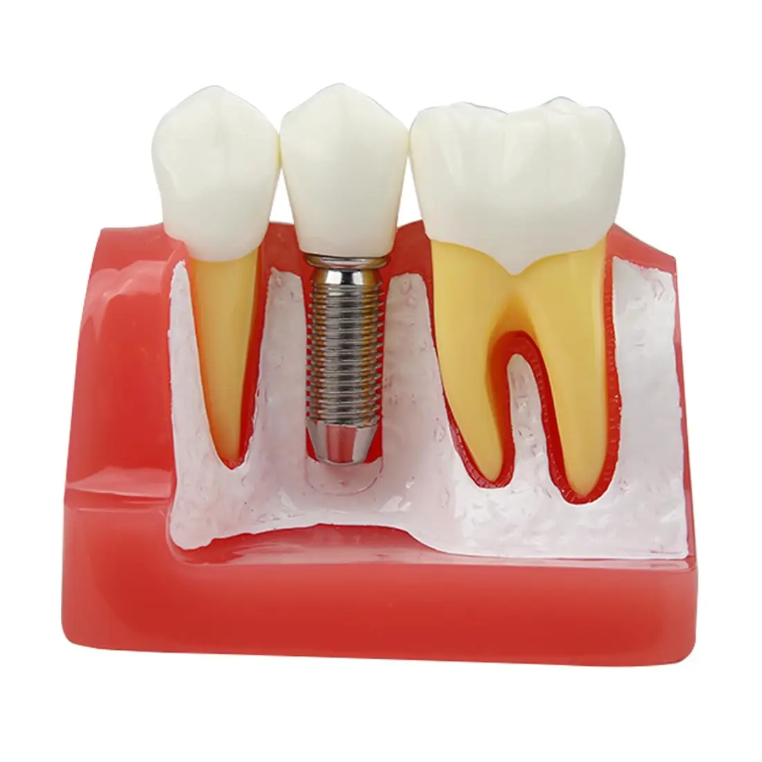 Image 4: Modèle d'implant dentaire AG, pont de couronne amovible, modèle de démonstration de dents 4 fois pour l'enseignement, l'éducation des patients