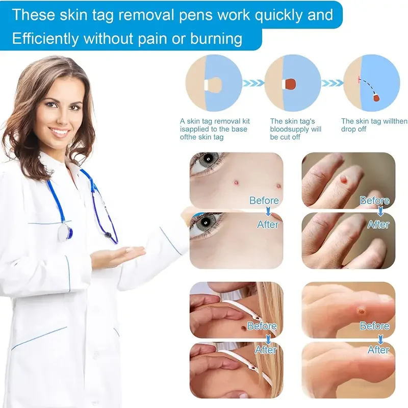 Body Wart Dot Behandelingen Remover Schoonheid Gezondheid 3 In 1 Pijnloos Auto Skin Tag Mol Wrattenverwijdering Kit Reinigingsgereedschap Gezicht Huidverzorging