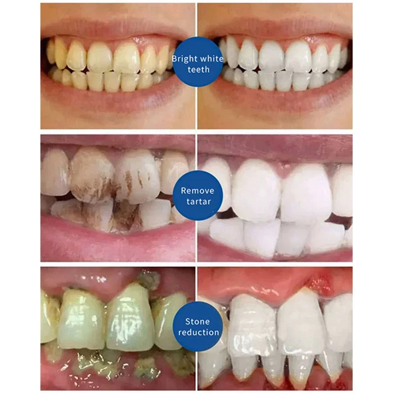 Sdatter Removal Of Plaque Stains Decay Repair Of Cavities Caries Whitening Yellowing Repair Teeth Teeth Whitening Toothpaste New