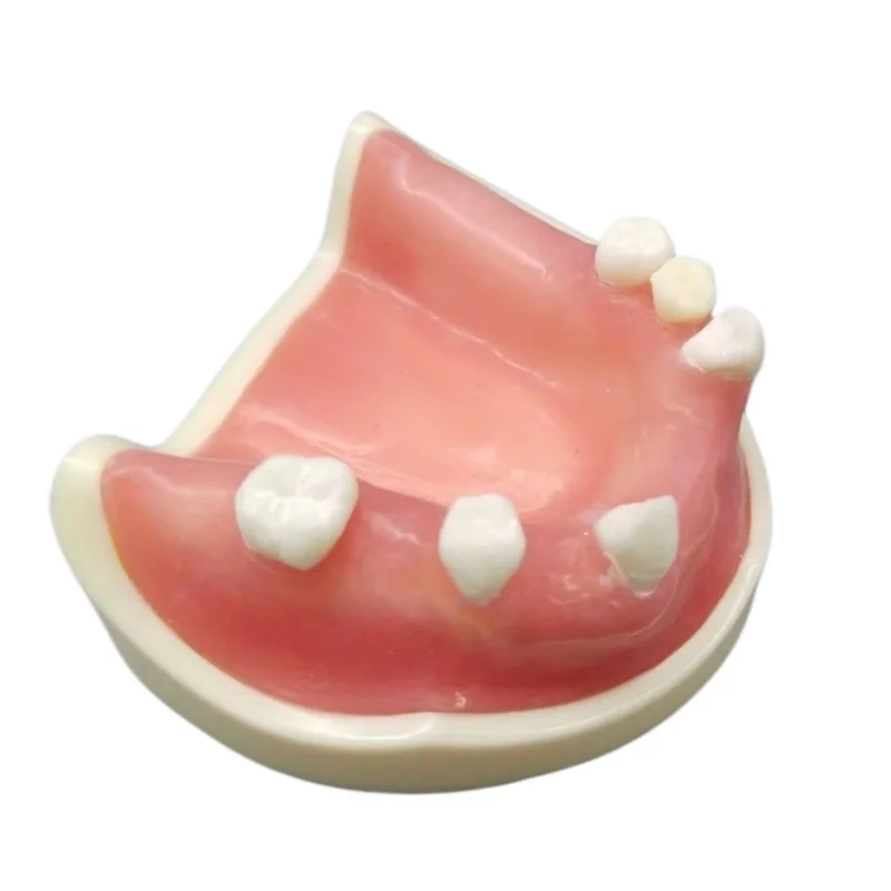 Teeth Loss Model Dental Implant Student Teaching Training Aid Practice Model Upper Jaw Lift Implants Restoration Model Lab