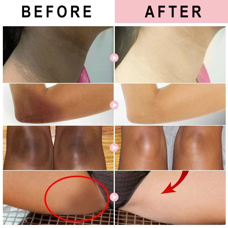 Creme de clareamento partes íntimas axilas soro de branqueamento clarear bunda joelho iluminar parte interna da coxa peças íntimas escuro remover melanina