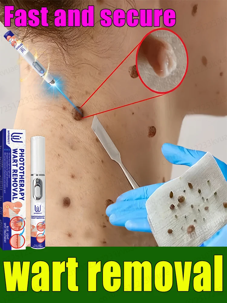 

Quickly remove warts and let beauty no longer be limited!