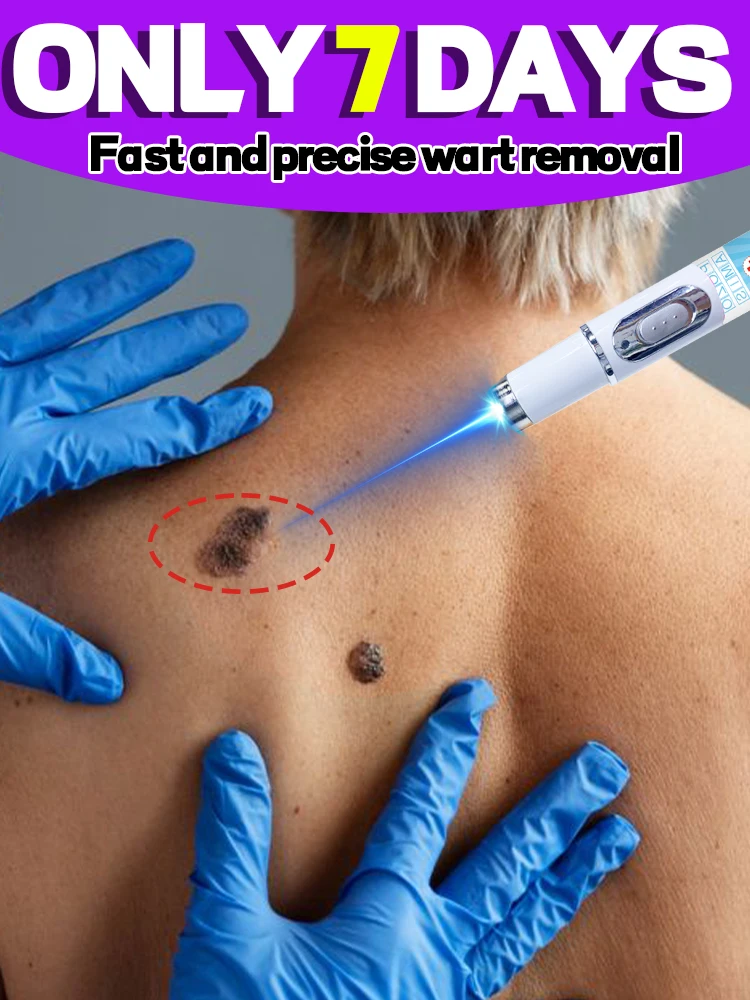 

La génération-2 laser dit au revoir aux verrues supprimer rapidement