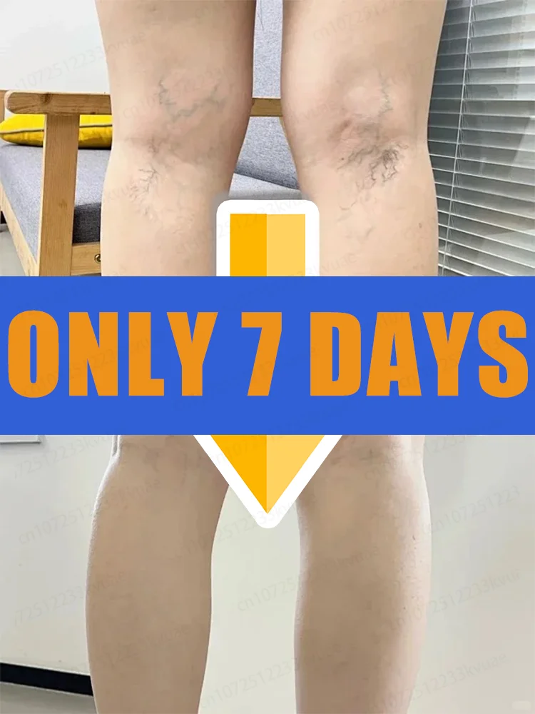

Generation-2 Laser Says Goodbye To Spider Legs Varicose In 7 Days