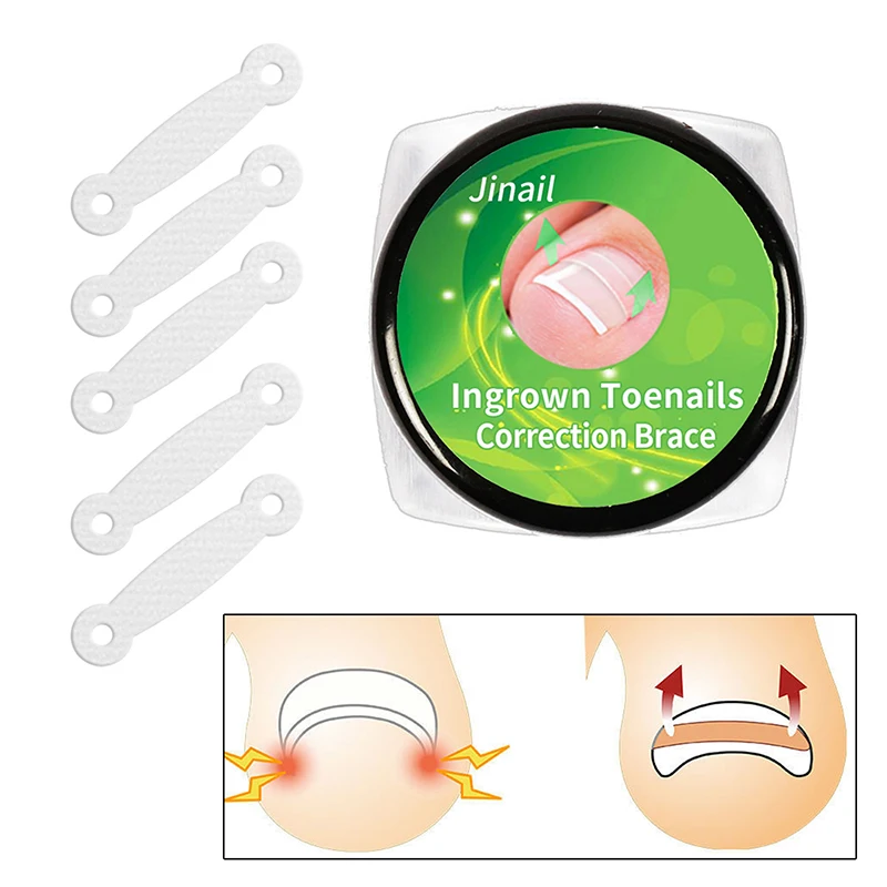 10 個陥入爪治療陥入爪矯正ツール弾性パッチステッカー矯正クリップブレースペディキュアツール