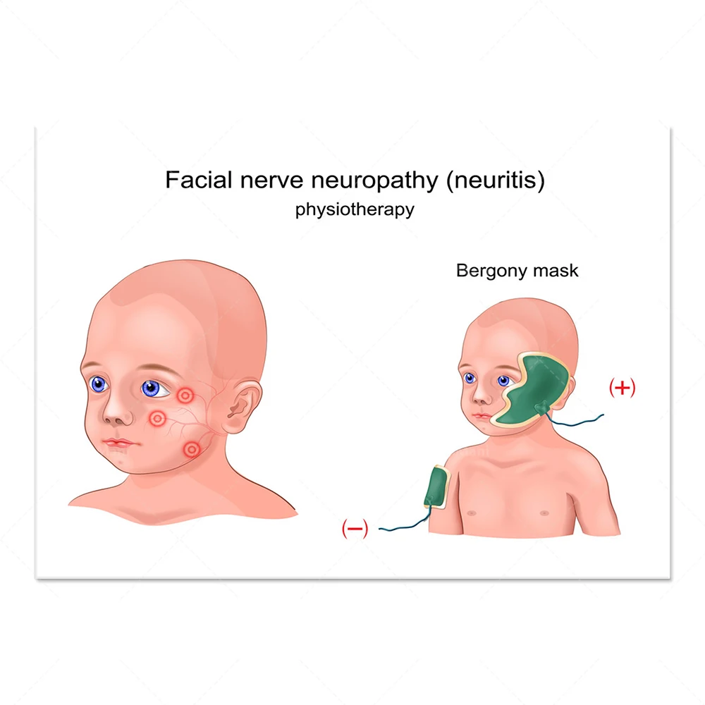 Facial neuritis anatomy engraving in children vector image, paediatric office decoration doctor gift typographic poster