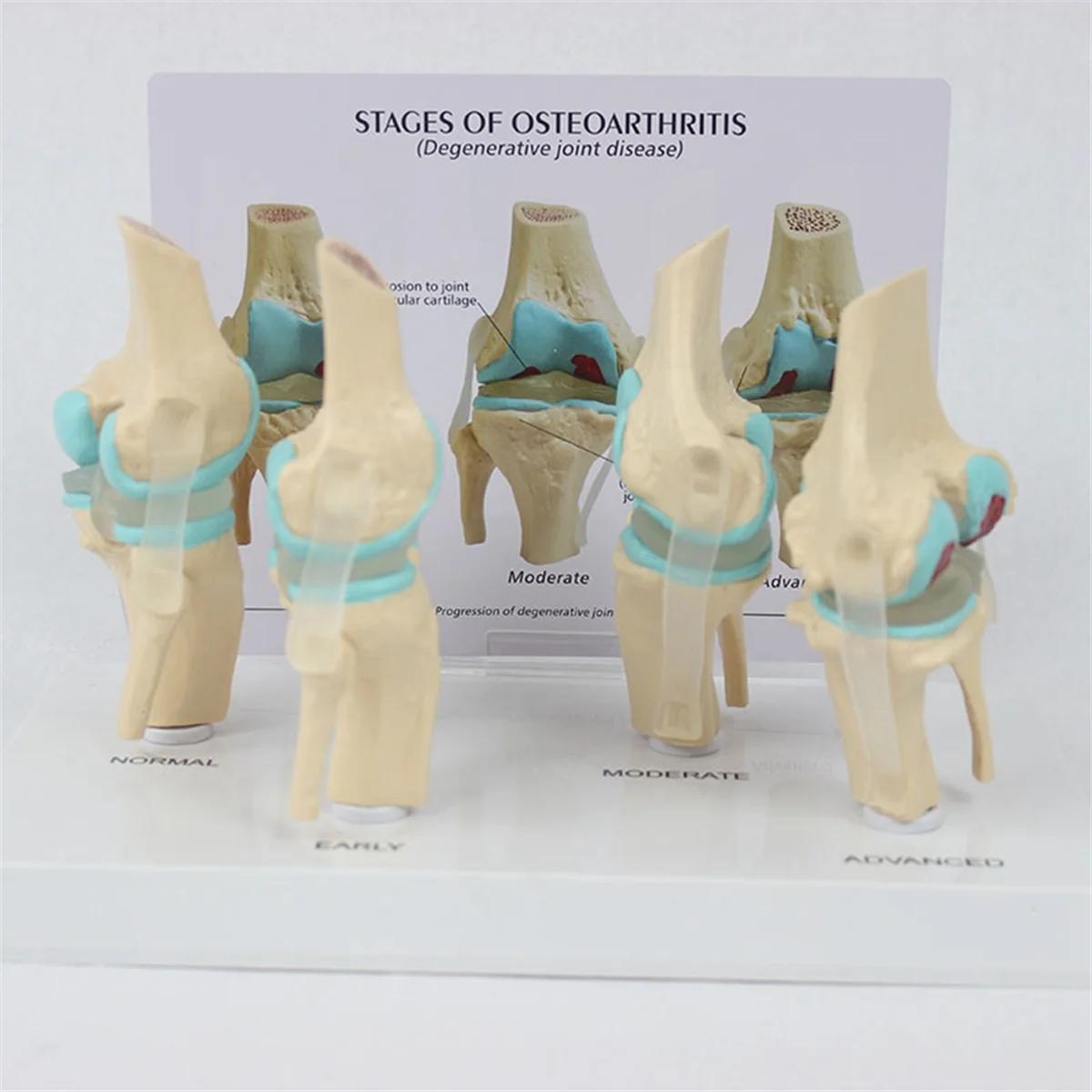 Knee Kit Osteoarthritis Anatomy Model with Educational Key Card 4 Stage Knee Model Orthopedic Teaching Aids