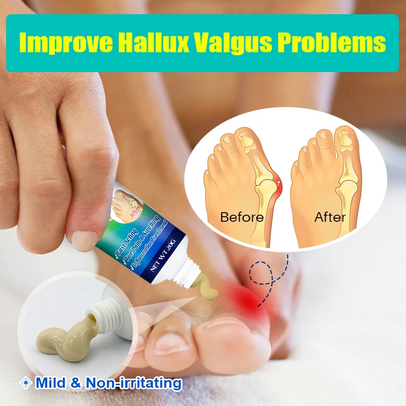 3Pcs Bunion Gout Treatment Cream Relieve Arthritis Pain Hallux Knee Lumbar Limb Stiffness Joint Valgus Corrector Ointment A990