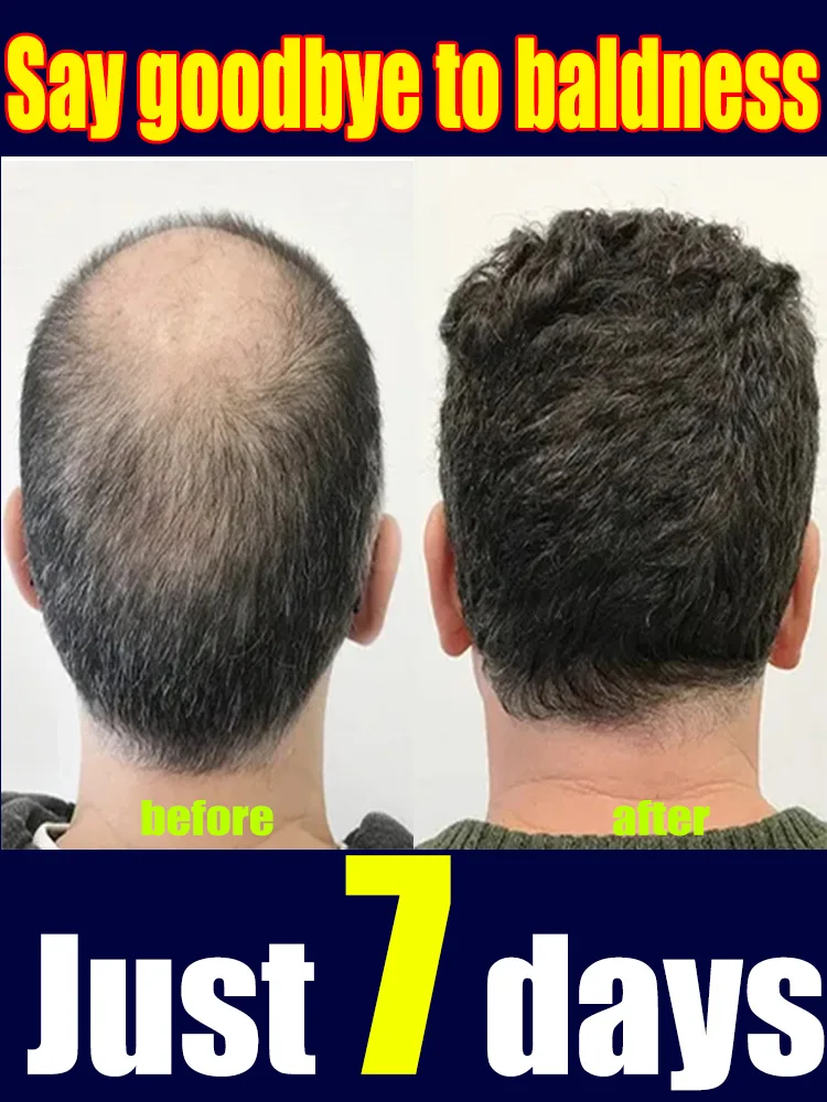 

98% of customers repurchase, have more and more hair, say goodbye to baldness